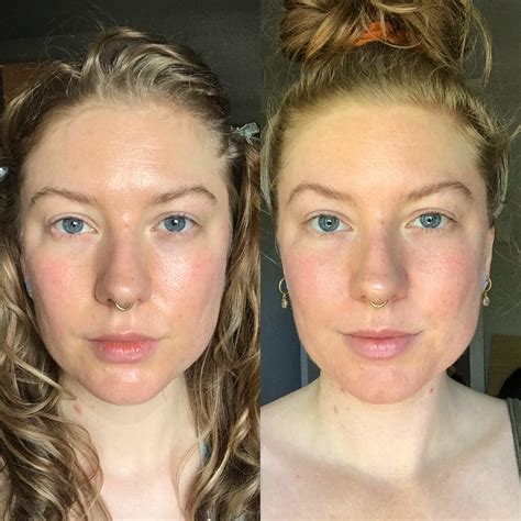 If you have thin skin and want to use tretinoin, you might want to dilute it with moisturizer and keep it away from your eyes. . Tretinoin anti aging before and after reddit